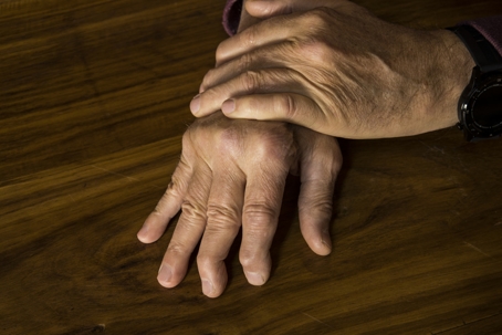 person with swollen knuckles
